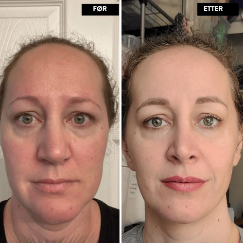 Lyselle™ – Næste generations alternativ til retinol