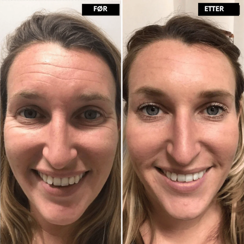 Lyselle™ – Næste generations alternativ til retinol