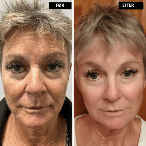 Lyselle™ – Næste generations alternativ til retinol