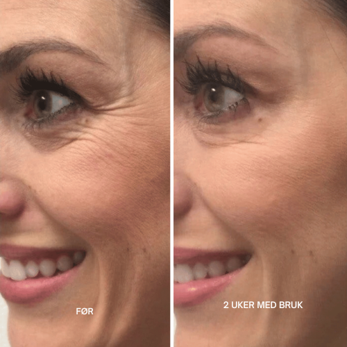 Lyselle™ – Næste generations alternativ til retinol