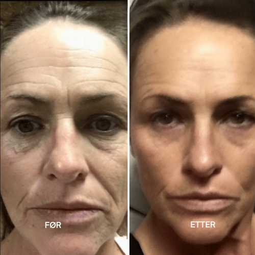 Lyselle™ – Næste generations alternativ til retinol